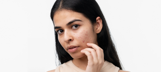 Acne Breakout? Here Are 5 Foods That May Be Causing It - Re'equil
