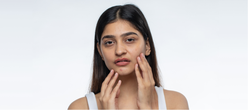 Is It Skin Purging or Breakout? Here Is How You Can Tell the Difference - Re'equil