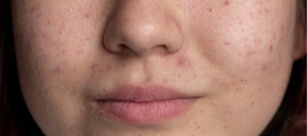 6 Ways to Fix Textured Skin According to Dermatologists Re equil
