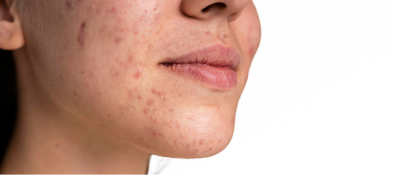 The Internet Says Cold Showers Reduce Acne—Is It True? - Re'equil