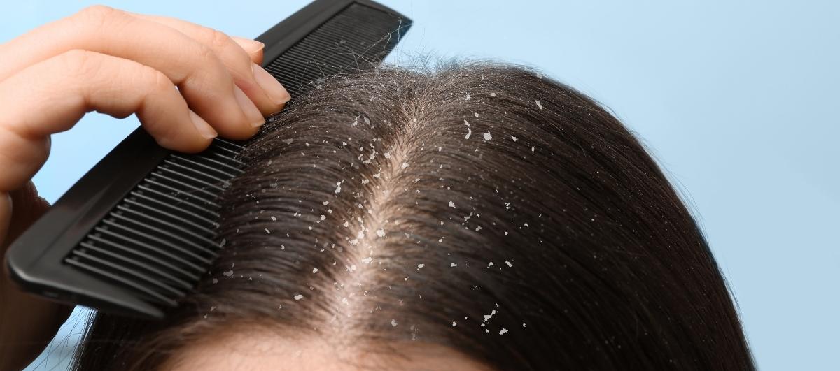 Get Rid Of Dandruff And Itchy Scalp With Zinc Pyrithione