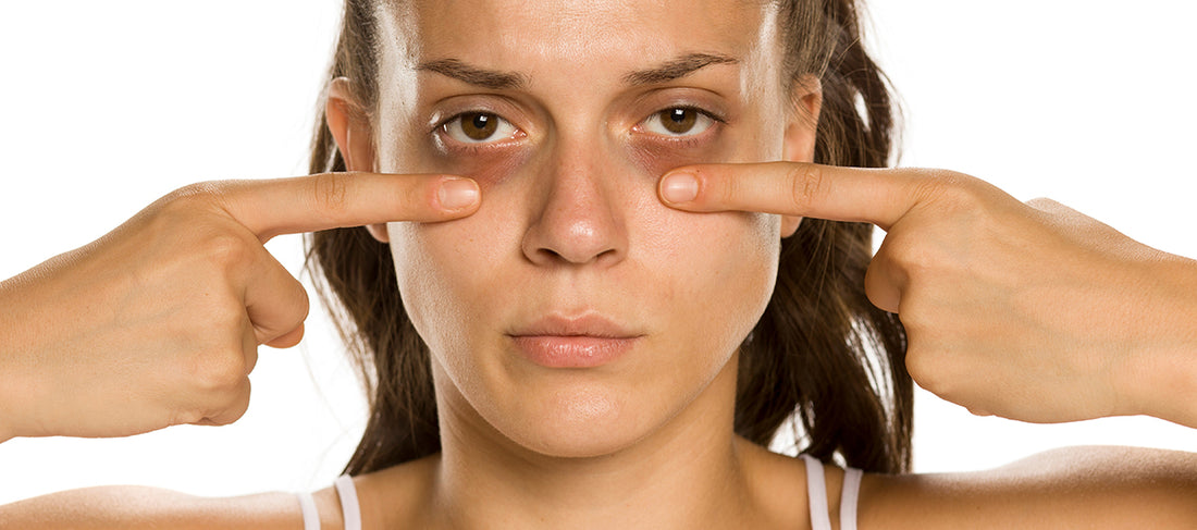 10 Effective Tips To Remove Under Eye Dark Circles