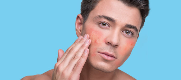 5 Ingredients To Avoid If You Have Sensitive Skin