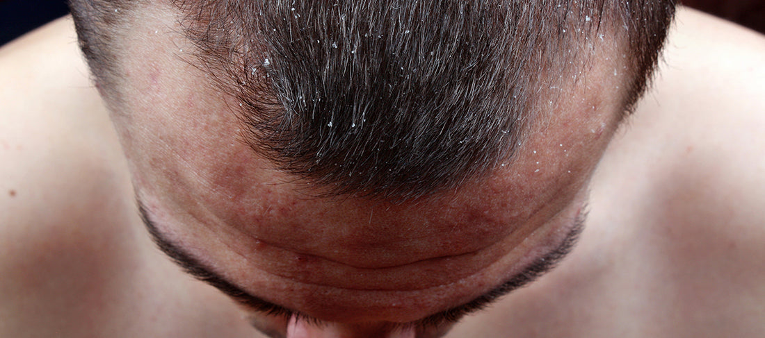 Top 7 Tips to Reduce Dandruff and Hair Fall Issues Naturally Remedies – Re'equil