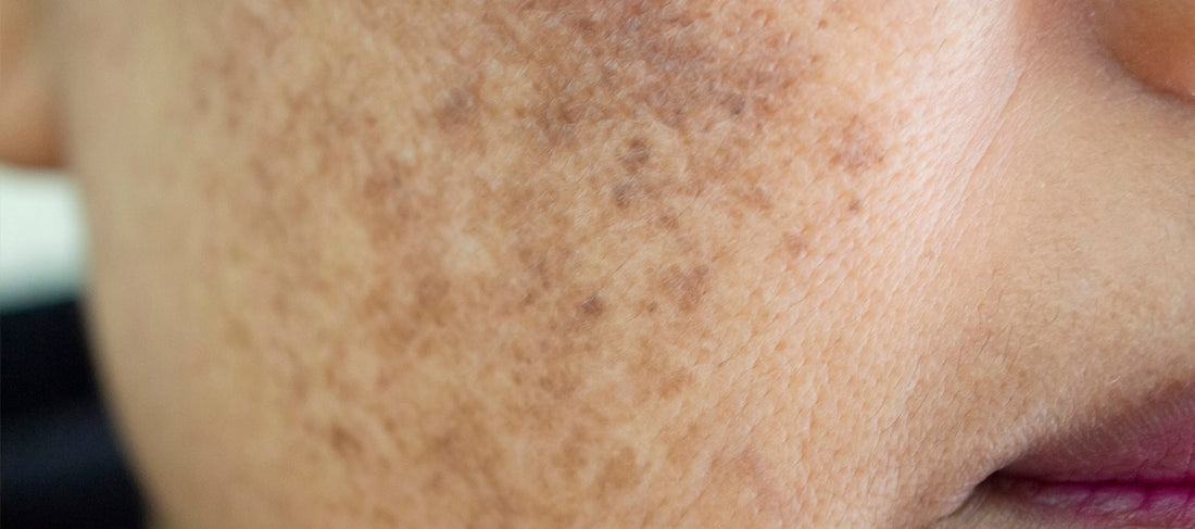 Home Remedies for Pigmentation on Face