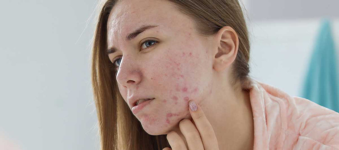 Foods That Cause Acne