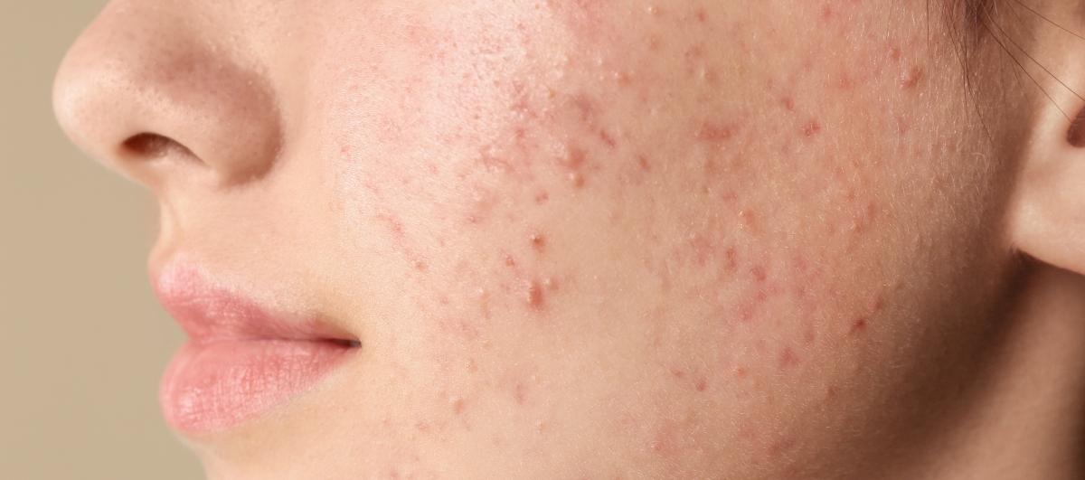 Few Lesser Known Reasons Why Niacinamide Products May Cause Breakouts – Re'equil