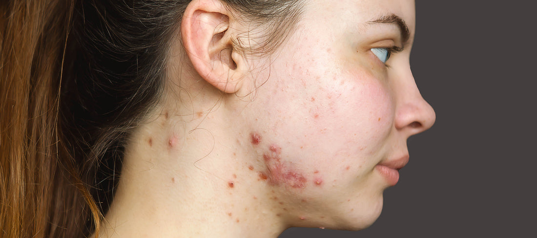 Best Tips To Stop Breakouts And Pimples