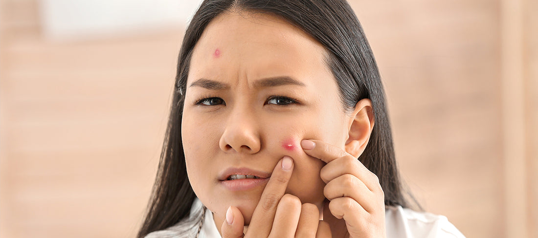 Blind Pimple: Its Causes And Treatment