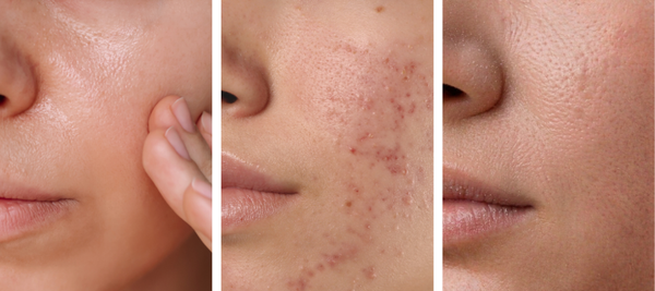 Oily, acne-prone & dehydrated: The most confusing skin type explained