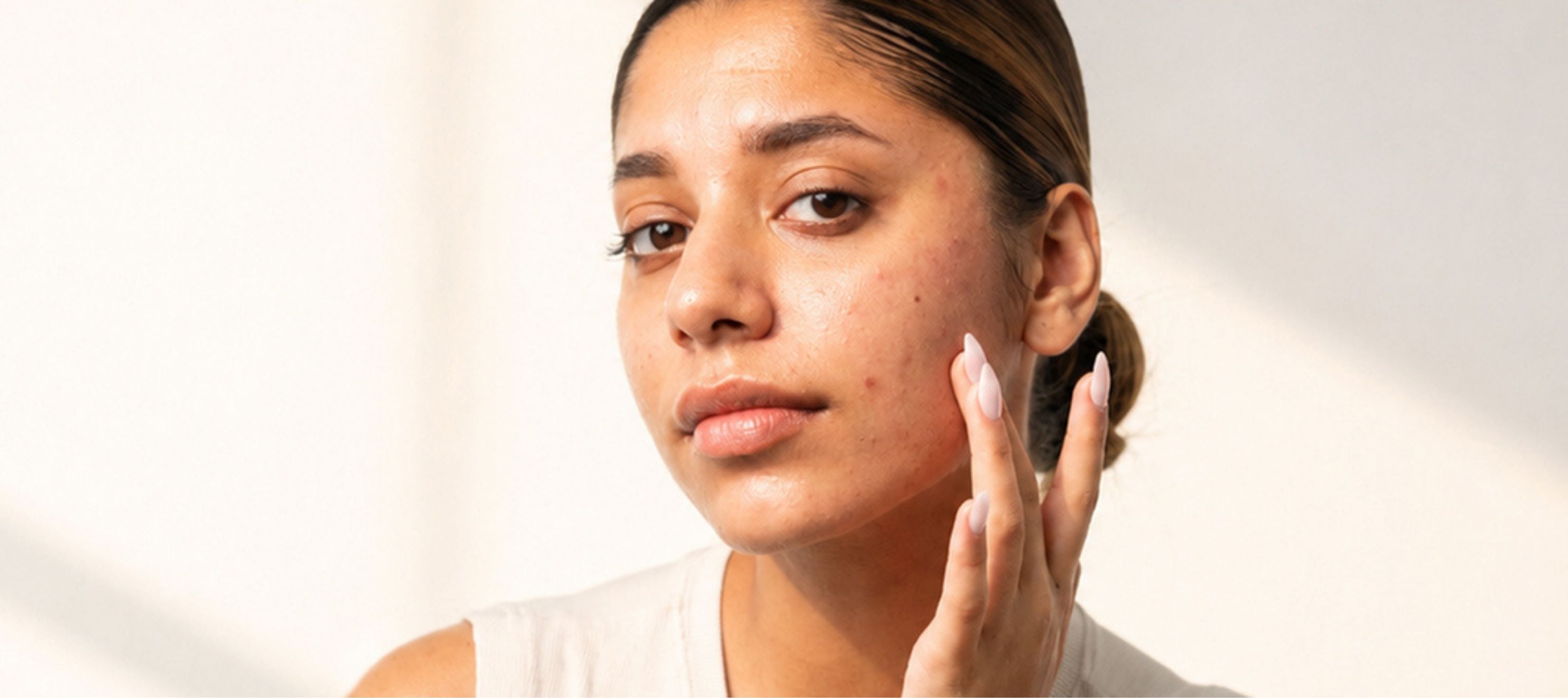 Why does summer heat cause sudden breakouts?