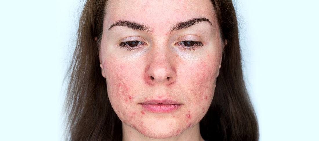 Causes and Treatment of Acne vulgaris