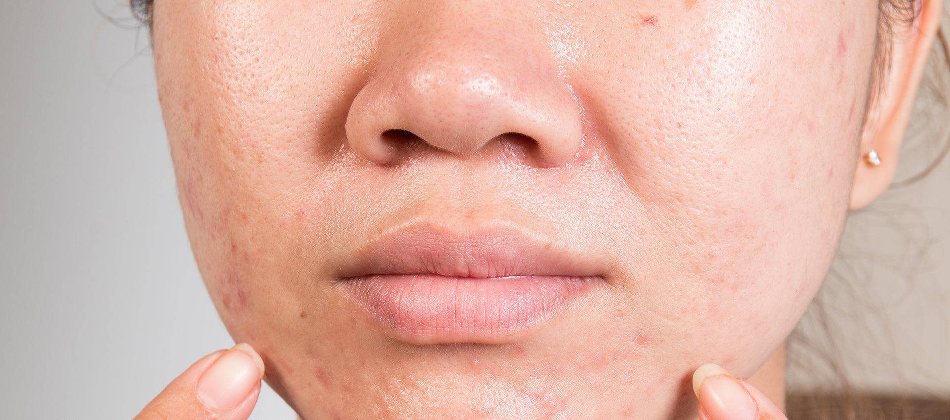 causes of oily skin