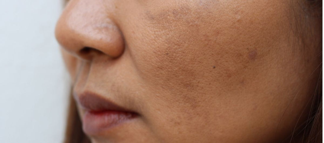 Chemical Peels VS Enzyme Peels - Which Is Good For Clear And Glowing Skin?