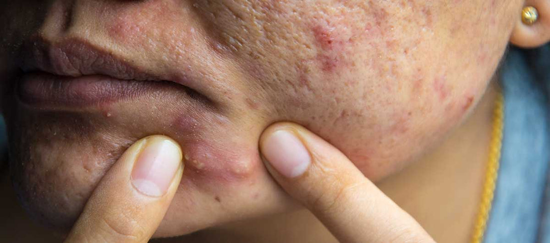 Large Pimples Exploding Cystic Acne Treatment - Pimple under the Skin – Re'equil