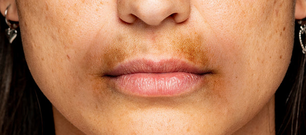 How to get rid of dark patches around the mouth?