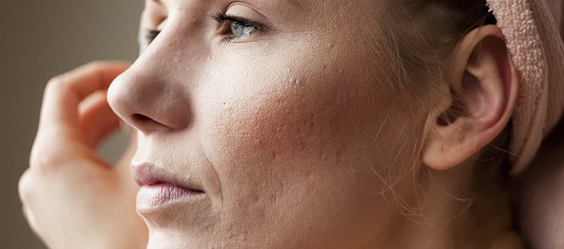 Difference Between Large Pores And Acne Scars