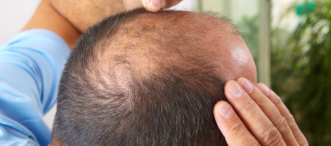 Different Types Of Hair Loss and Ways To Treat Them