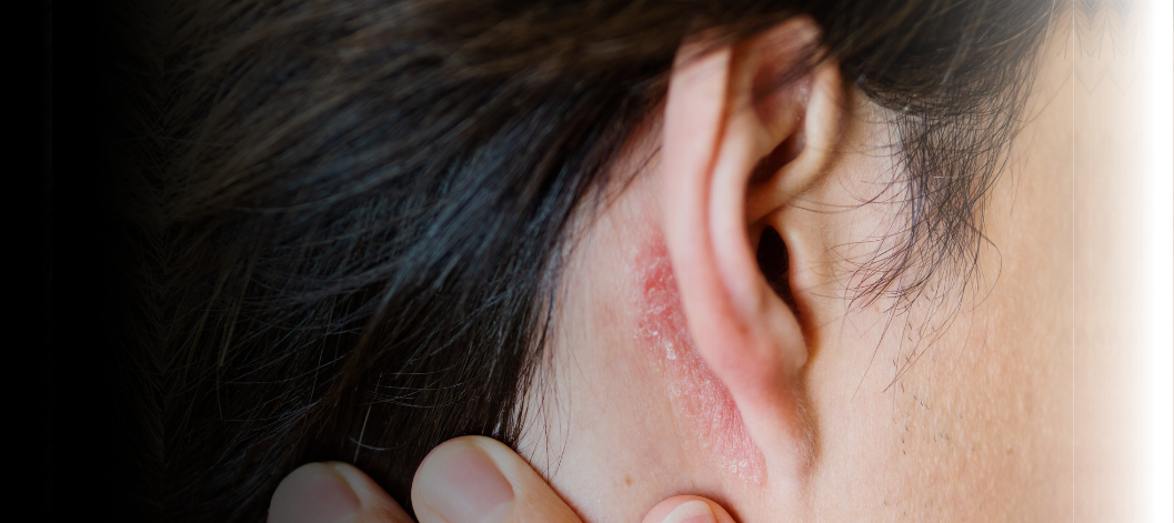 8 Most Effective Ways To Treat Dry Behind Your Ears Re equil 8 Most Effective Ways To Treat Dry Behind Your Ears Re equil