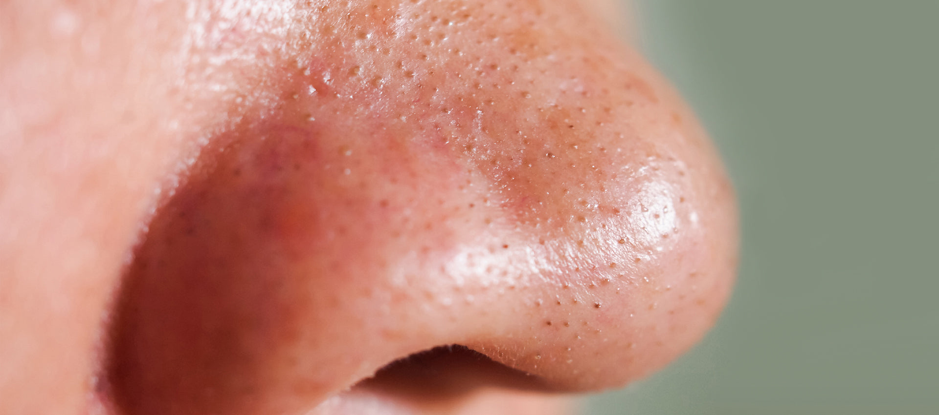 Sebum Clogs Facts About Blackheads - Sebum Clogged Pores – Re'equil
