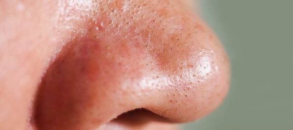 Facts About Blackheads