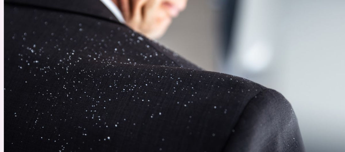 5 Simple And Effective Tips To Get Rid Of Dandruff This Monsoon