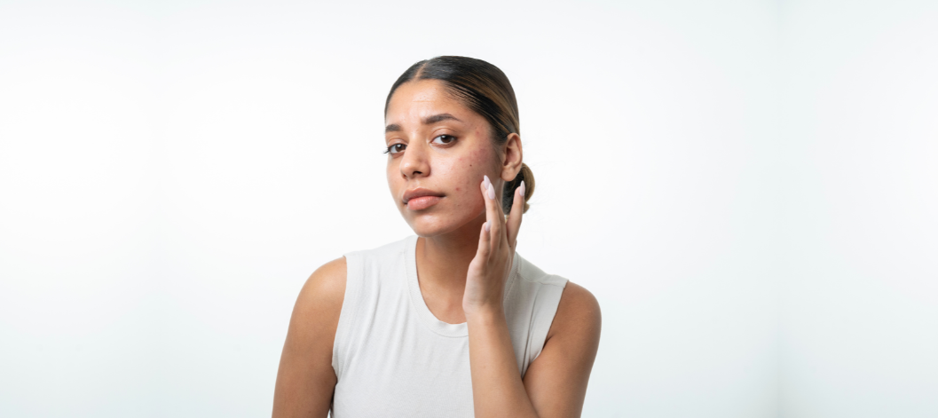 Does Glycolic Acid cause skin purging?