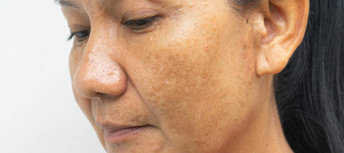 My Mom and Hyperpigmentation – Diagnosis to Solution