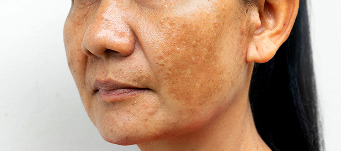 Blotchy skin: Know its causes and effective solutions