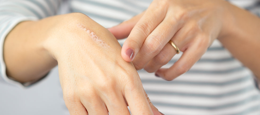 How To Get Rid Of Burn Marks And Scars At Home