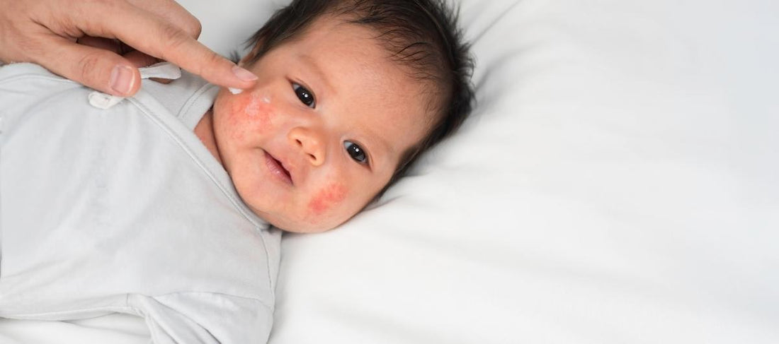 Initial Signs Of Eczema In Kids And The Best Prevention Tips To Follow