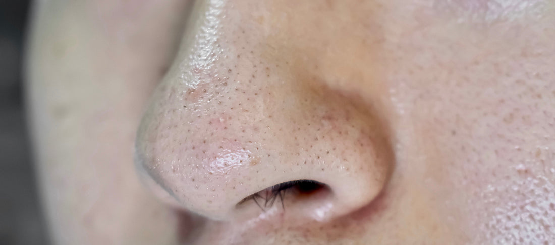 Remove Blackheads and Minimize Pores