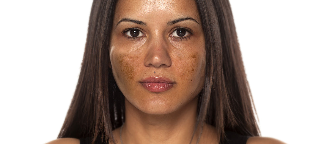 Tips to Prevent Hyperpigmentation | Dark Patches on Skin