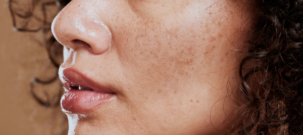 Hyperpigmentation on Indian Skin - Key Causes & Effective Solutions