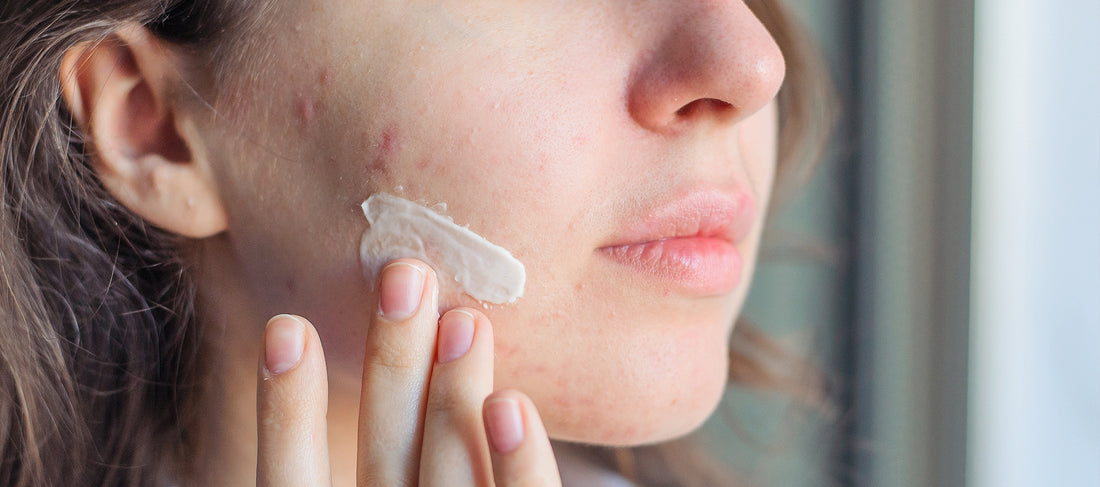 Insight On Salicylic Acid For Acne-prone Skin
