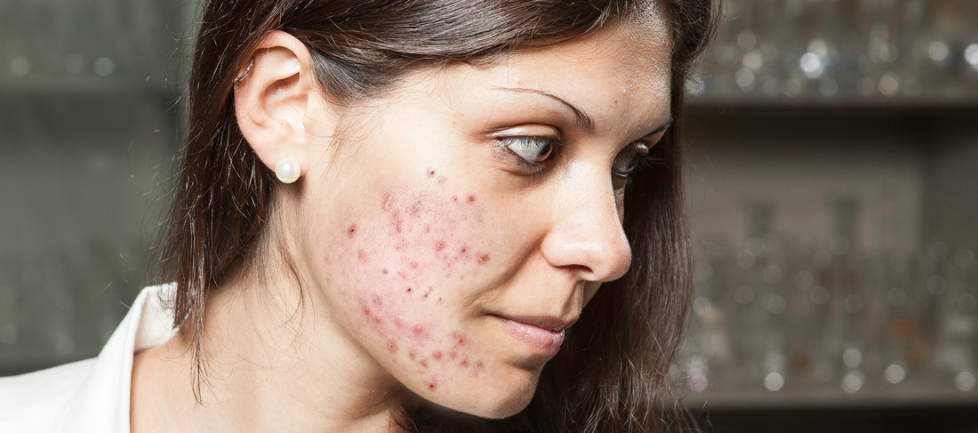 Know The Link Between Acne And Diet