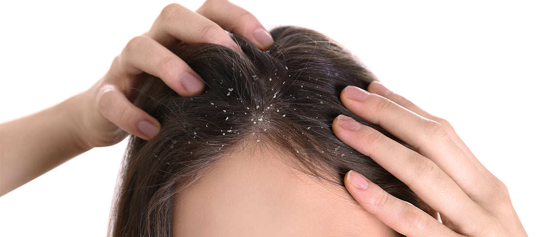 Know Why Dandruff Gets Worse During Winters