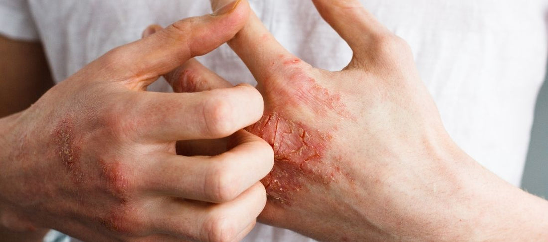 Learn about Atopic Dermatitis: Causes, Symptoms and Treatment