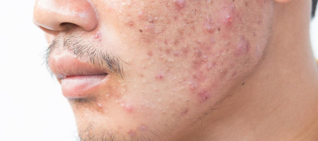 Life Cycle Of Acne, How It Forms, And Treatment