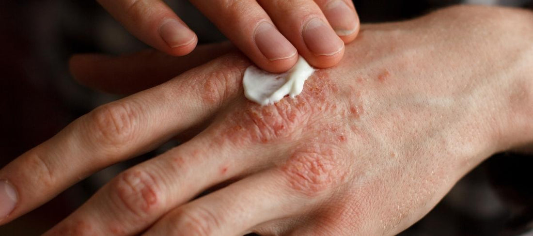10 Effective Ways To Tame Hand Eczema
