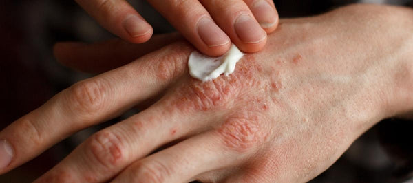 10 Effective Ways To Tame Hand Eczema