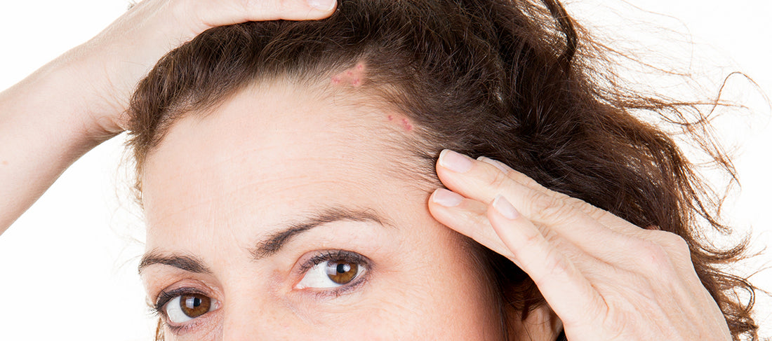 Reasons Behind Pimples On Scalp