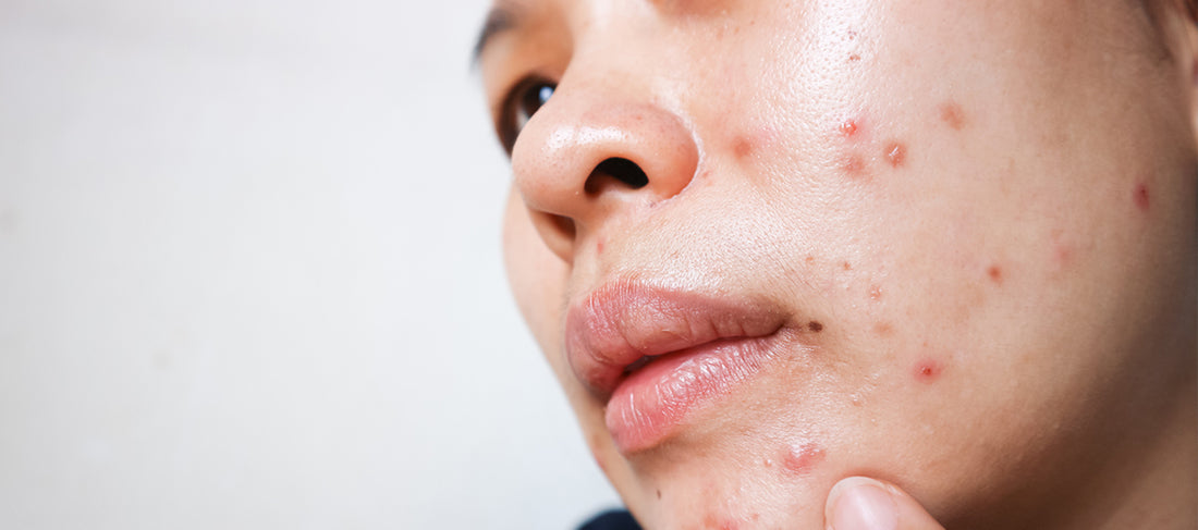 Reasons for Adult Acne