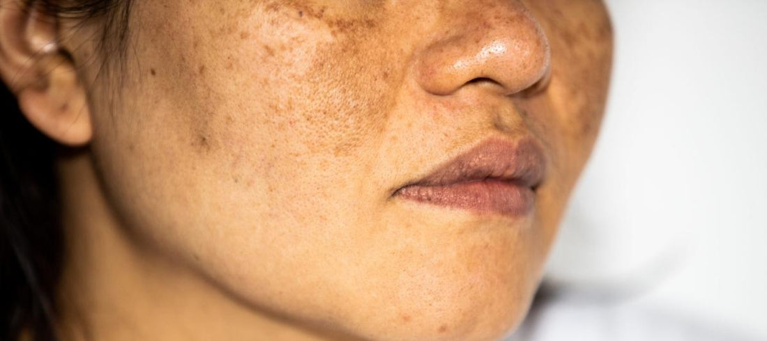  Hyperpigmentation Making You Stressed? 5 Mantras To Swear By