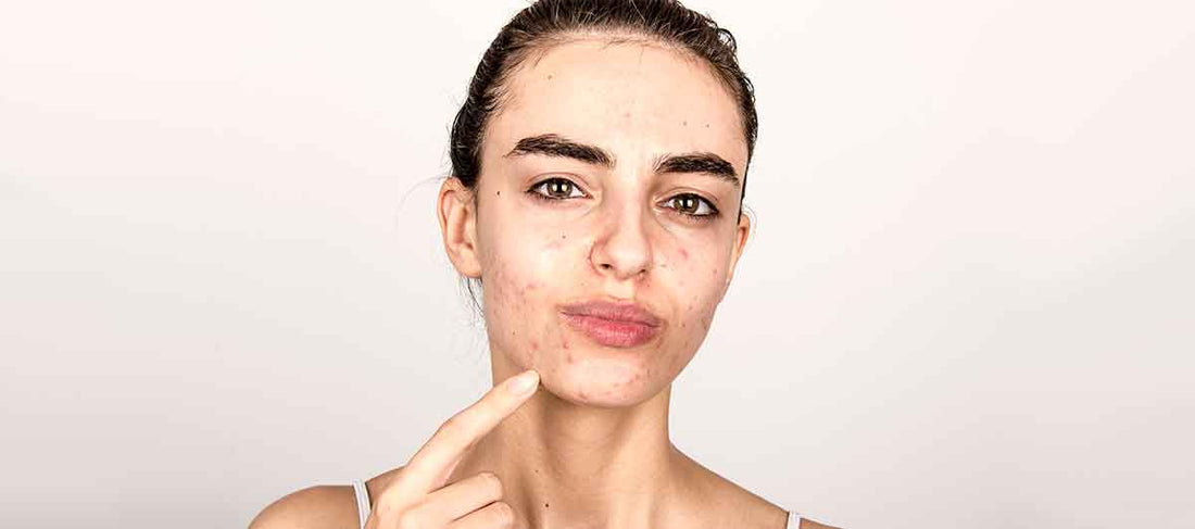 Home Remedies for Acne Prone Skin