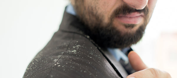Top 11 Home Remedies To Get Rid Of Dandruff