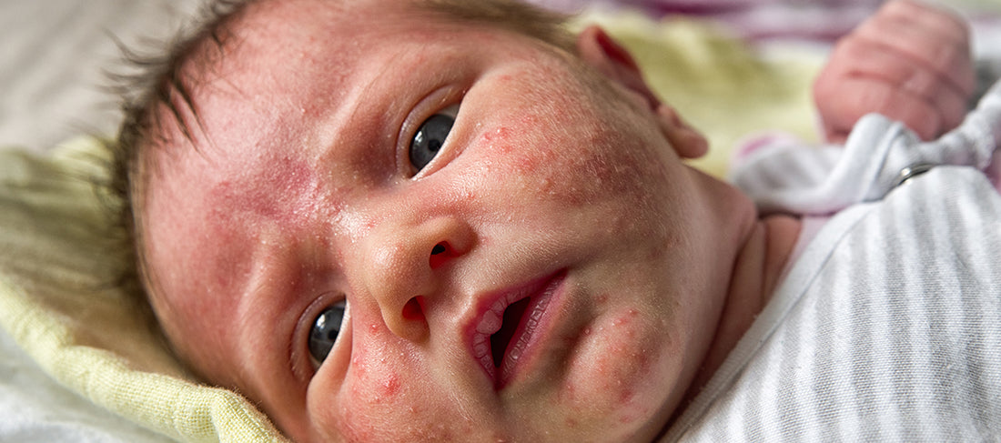 Top 5 causes of acne in toddlers