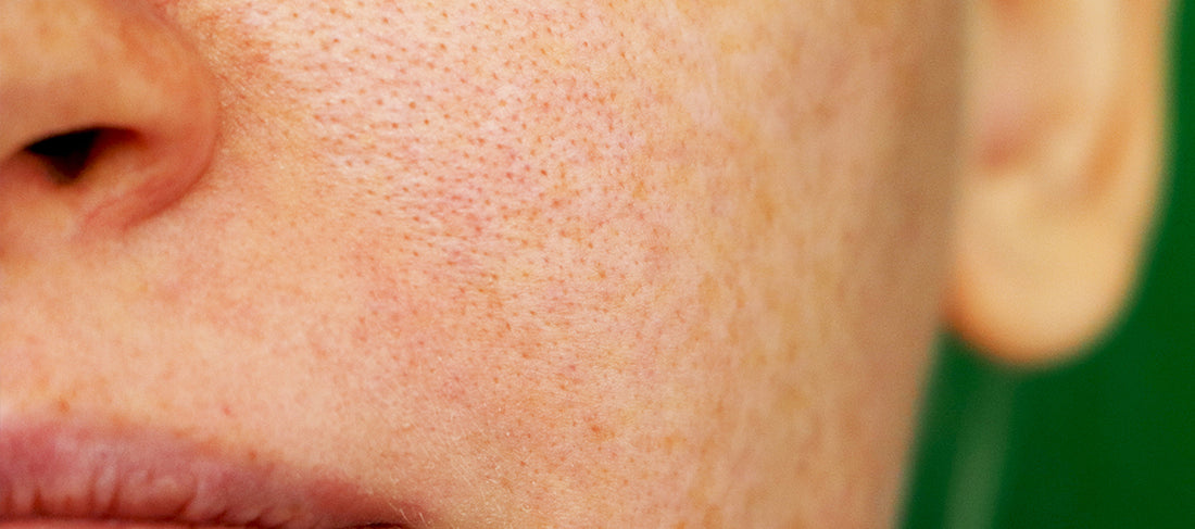 Top 7 Home Remedies For Open Pores