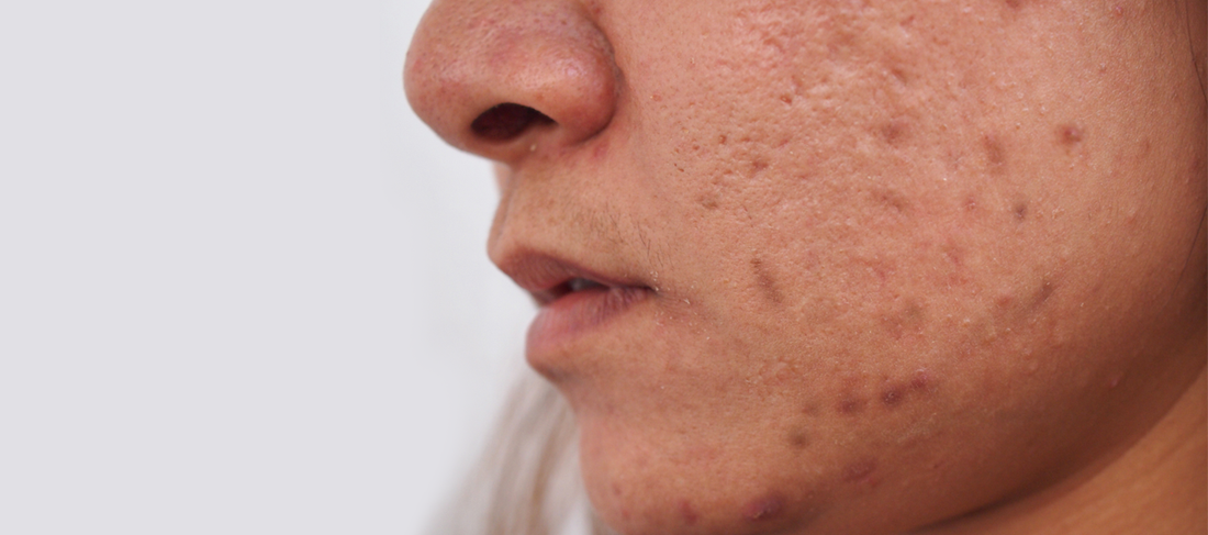2 Potent Ingredients To Pair Against Acne Scars & Dark Spots