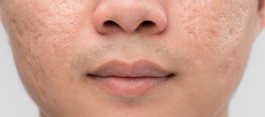 Types of Acne Scars